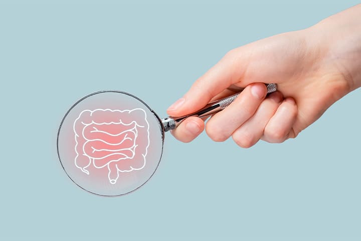 炎症性腸疾患(IBD：潰瘍性大腸炎クローン病)